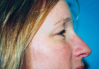 Eyelid Surgery (Belpharoplasty) before 265352