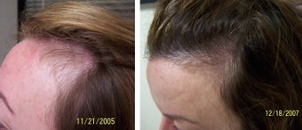 Female medical treatment for hair loss (no surgery) after 369186