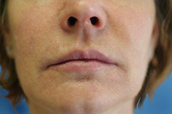 Silicone Microdroplets for Lip Augmentation after 109218