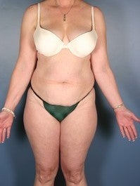 Tummy Tuck before 374140