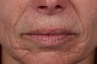 Radiesse to Lower Face before 309746