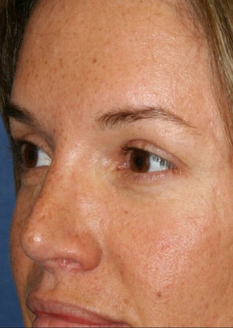 Rhinoplasty and Brow Lift after 142527