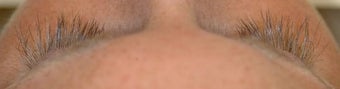 Latisse treatments for eyelashes after 105271