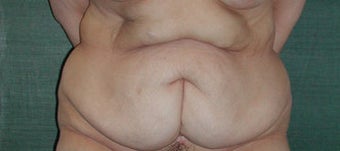 Lower body lift for massive weight loss before 117047