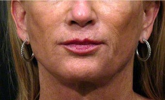 Sculptra, Juvederm, Obagi before 320649