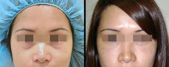 Lower Eyelid(Blepharoplasty) Surgery before 652331