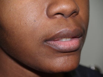 Upper Lip Lift before 405416