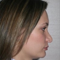 Revision Rhinoplasty before 443004