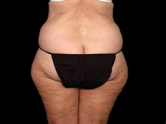 Lift of Thighs, Hips, and Butt before 230714