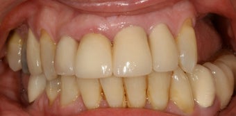 Dental implants, bone grafts, all porcelain crowns before 503116