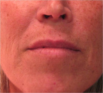 Juvederm to the upper lip before 77461
