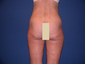 Thigh Liposculpture before 66003