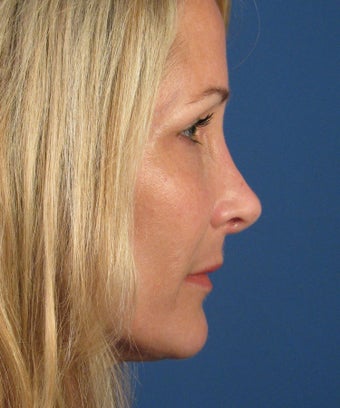 Revision Rhinoplasty 410807