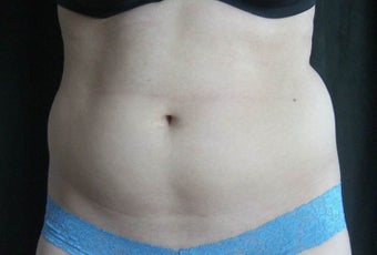 Smartlipo before 512652