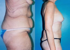 Upper Body & Back Lift After Major Weight Loss before 352828