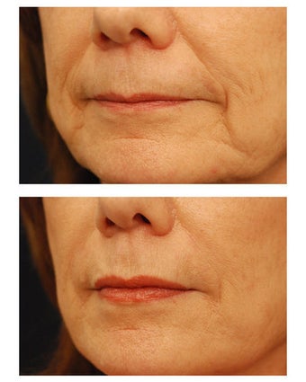 Juvederm before 301155