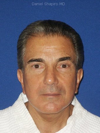 Facelift, Endoscopic Browlift, Upper and Lower Blepharoplasty with canthopexy. after 249291