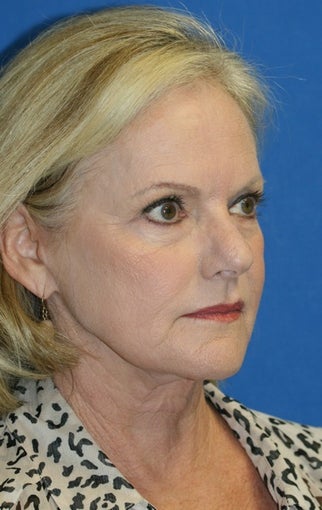 Short Incision Facelift and Lateral Browlift before 392435