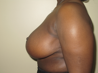Breast Reduction 410405