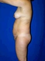Tummy Tuck (Abdominoplasty) 483695
