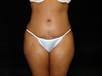 Standard Abdominoplasty after 203398