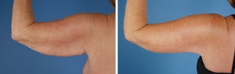 Arm Lift (Brachioplasty) 303695