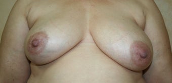 Breast Reconstruction before 526415