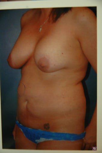 Mommy makeover before 236172