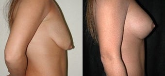 Breast Lift and Augmentation before 110087