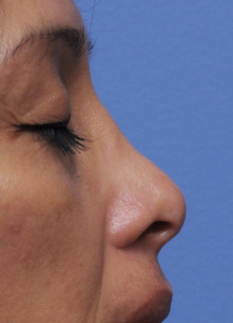 Non-Surgical Nose Job 430195