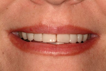 Smile Makeover before 231519