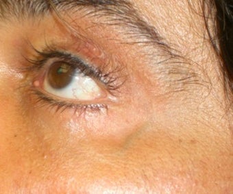 Laser Vein Treatment before 374366