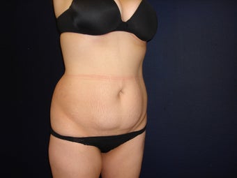 Abdominoplasty with liposuction of flanks before 300372