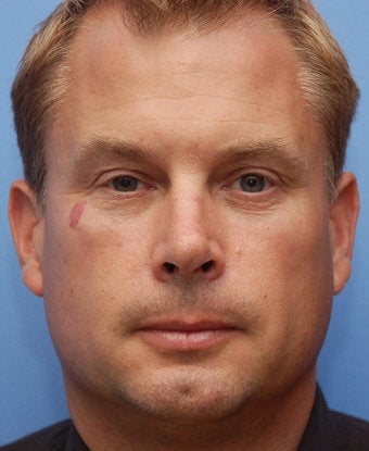 Cheek Dermafiller, Under Eye Dermafiller after 442078