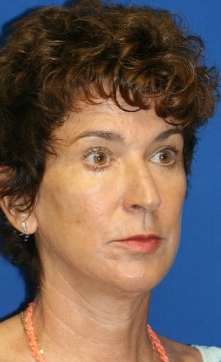 Facelift, Lateral Browlift, Fat Transfer, Chemical Peel 399966