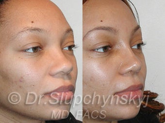 African American Rhinoplasty 525580