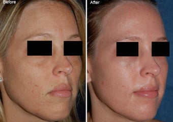 Fraxel Laser Resurfacing before 97890