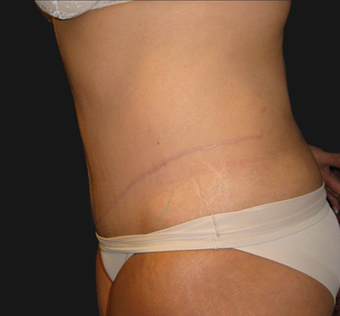 Abdominoplasty 458935