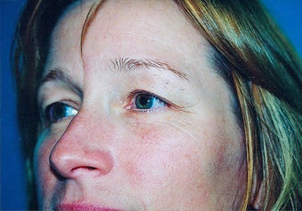 Eyelid Surgery (Blepharoplasty) before 265347