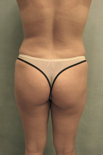Brazilian Butt Lift before 76682