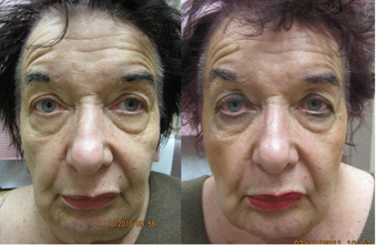 Sculptra facial rejuvenation before 390198