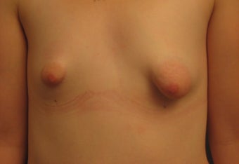 Reconstruction of Tubular Breast Deformity before 555981
