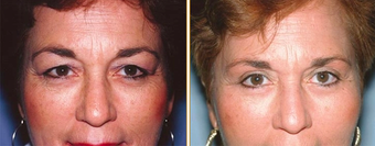 Eyelid Surgery before 271174