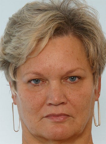 Botox Juvederm Restylane Radiesse before 260316