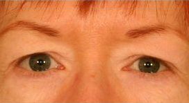 Upper Blepharoplasty (Upper Eyelids) before 376859