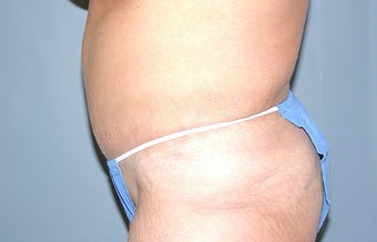 Abdominoplasty with power-assisted liposuctoin after 512248