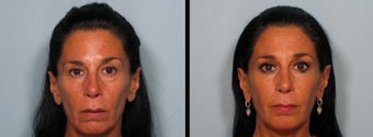 Sculptra before 460591