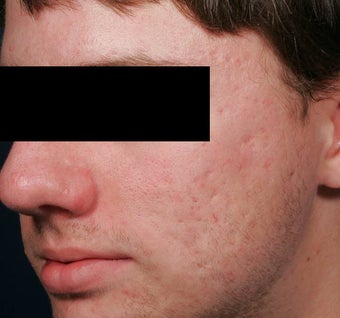 Fraxel -acne scars before 136197