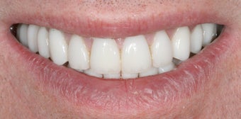 Porcelain crowns and porcelain veneers after 486463