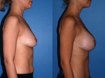 Breast Augmentation - Silicone Implants after 125318